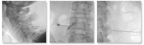 x-ray of needle based procedure